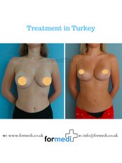 Breast Lift - Formedi Clinic Turkey