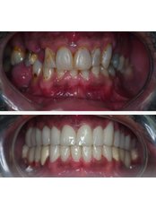 Dental Crowns - Hylia Health