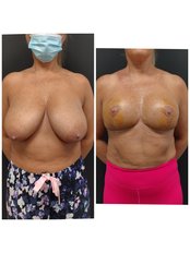 Breast Lift - NewMe Health Clinic