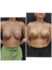 Breast Implants - NewMe Health Clinic