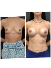 Breast Implants - NewMe Health Clinic