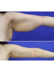 Arm Lift - Op. Dr. Harun Şimşek- Estetik ve Plastik Cerrahi Kliniği