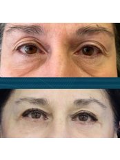 Eyelid Surgery - Op. Dr. Harun Şimşek- Estetik ve Plastik Cerrahi Kliniği