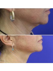Double Chin Surgery - Op. Dr. Harun Şimşek- Estetik ve Plastik Cerrahi Kliniği