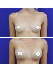 Breast Implants - Op. Dr. Harun Şimşek- Estetik ve Plastik Cerrahi Kliniği