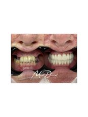 Dental Implants - Road to Smile Antalya