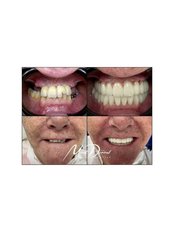 Dental Implants - Road to Smile Antalya
