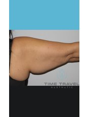 Arm Lift - Time Travel Aesthetic