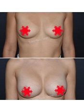 Breast Lift - Turkey Plastic Surgery