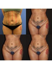 Liposuction - Dr Bulent Demir