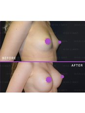 Breast Implants - Dr Duygu Aksoy Clinic