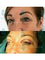 Eyelid Surgery - Ephesus Aesthetic
