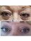 Transform AfterCare - EYELID SURGERY 