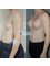 Transform AfterCare - BREAST IMPLANTS 