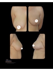 Breast Reduction - AKTIP Hospital