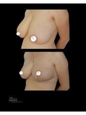 Breast Reduction - AKTIP Hospital