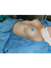 Breast Implants - Dr. MFO - Art, Surgery & Beauty