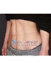 Liposuction - Dr. MFO - Art, Surgery & Beauty
