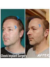 Cheek Implants - Dr. MFO - Art, Surgery & Beauty