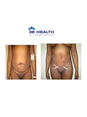 Full Abdominoplasty - 3B Health Clinics