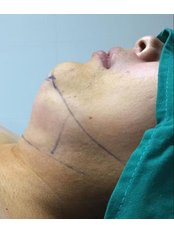 Neck Liposuction - Assoc. Professor Fatih Irmak, Aesthetic&Plastic Surgery Center