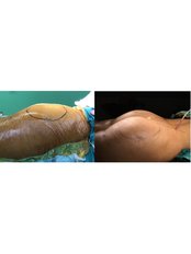 Butt Implants - Assoc. Professor Fatih Irmak, Aesthetic&Plastic Surgery Center