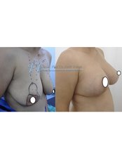 Breast Lift and Implant - Assoc. Professor Fatih Irmak, Aesthetic&Plastic Surgery Center