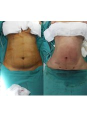 Liposuction - Assoc. Professor Fatih Irmak, Aesthetic&Plastic Surgery Center