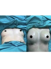 Breast Implants - Assoc. Professor Fatih Irmak, Aesthetic&Plastic Surgery Center