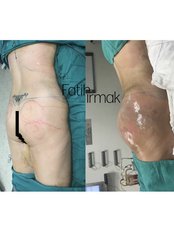BBL - Brazilian Butt Lift - Assoc. Professor Fatih Irmak, Aesthetic&Plastic Surgery Center