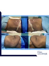 Tummy Tuck - Assoc. Professor Fatih Irmak, Aesthetic&Plastic Surgery Center