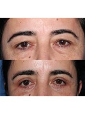 Eyelid Surgery - Assoc. Professor Fatih Irmak, Aesthetic&Plastic Surgery Center