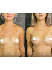 Breast Lift - Clinicos