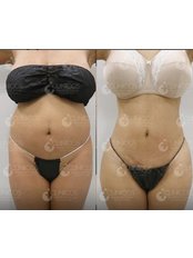 Liposuction - Clinicos