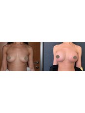 Breast Implants - Sener Kucuk
