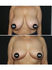 Breast Reduction - Sener Kucuk