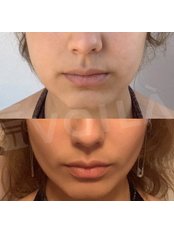 Buccal Fat Removal - Voilà Clinic