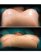 Breast Implants - Voilà Clinic
