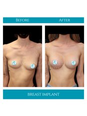 Breast Implants - Voluntas Health
