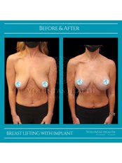 Breast Implant Revision - Voluntas Health