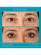 Eyelid Surgery - Voluntas Health