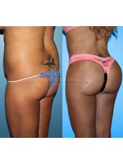 BBL - Brazilian Butt Lift - Voluntas Health