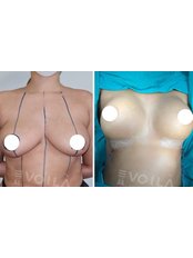 Breast Implants - Dr. Malik Abaci