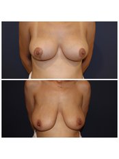 Breast Lift with Reduction - Trioklinik