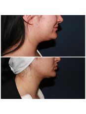Chin Implant - Trioklinik