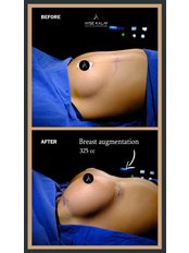 Breast Implants - Astera Clinic