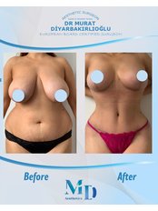 Breast Reduction - MD Aesthetics