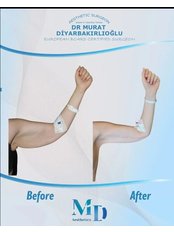 Arm Lift - MD Aesthetics