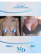Breast Lift - MD Aesthetics