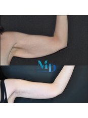Arm Lift - MD Aesthetics